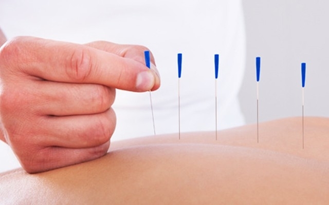Akupunktur nedir kimlere ve nasıl yapılır?