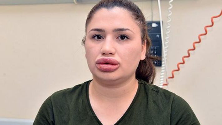 Adana'da dudaklarına silikon yaptıran hemşire Merve Keleş'in son hali
