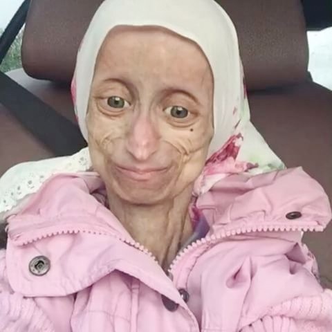 Progeria nedir? Erken yaşlanma hastalığı nedenleri?